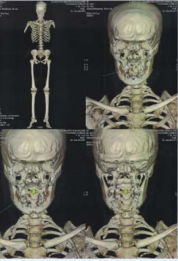 A scan taken a few minutes earlier clearly shows the absence of any such object in the oral cavity.